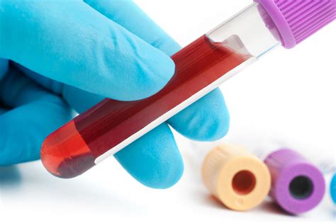 running and dropping test tube|Updated Phlebotomy Tube Color Chart and Test Associations.